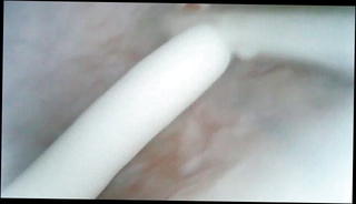 Watch the video about Look inside bladder with endoscope and inject white lube