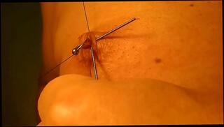 Watch the video about Play piercing with acupuncture 1